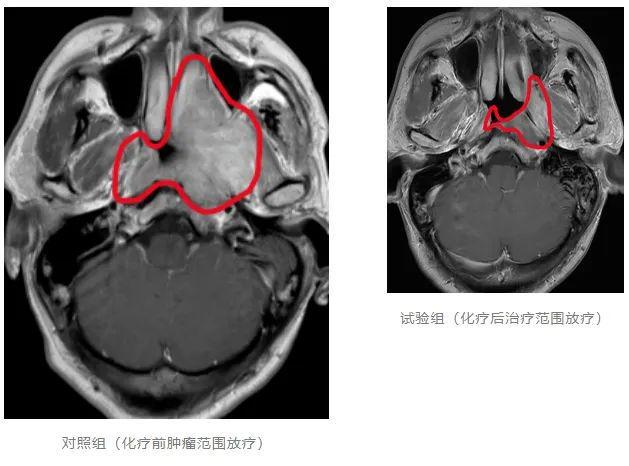 B体育：从保生存到优生存！国际神刊CA全球首篇临床试验论著来自中国(图2)